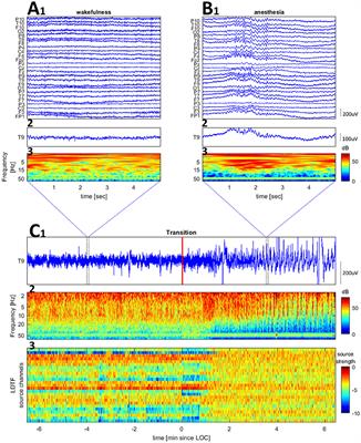 Distinguishing Anesthetized from Awake State in Patients: A New Approach Using One Second Segments of Raw EEG
